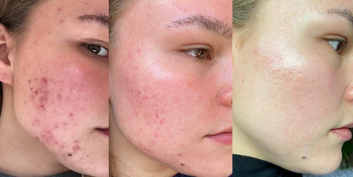 andreas-historie-skinsecret