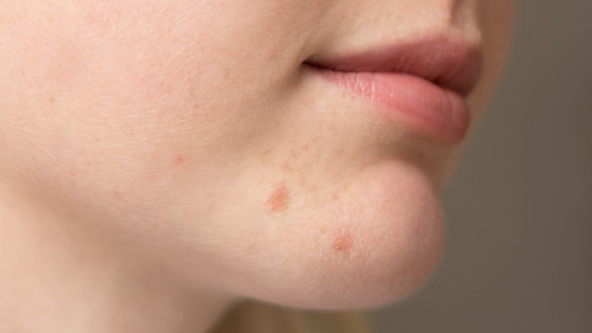 Tips for perioral dermatitt