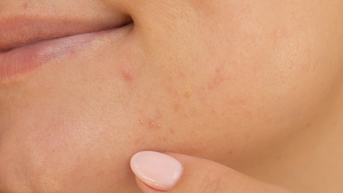 Skin purging vs. kviseutbrudd - hva er forskjellen?