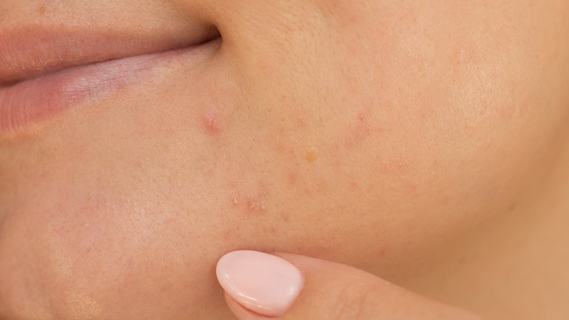 Skin purging vs. kviseutbrudd - hva er forskjellen?