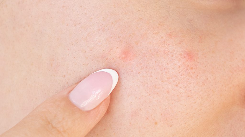 Hvorfor får jeg mer kviser når det blir kaldere?